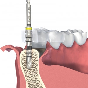 chirurgie-implantaire-01