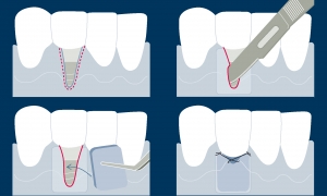 chirurgie muco-gingivale et recouvrement