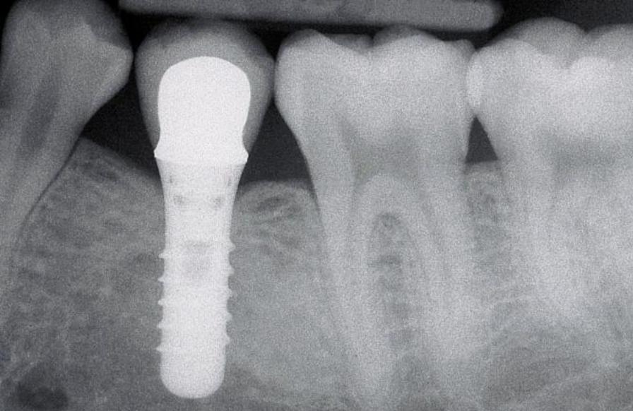 entretien-implant-01