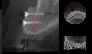 radiographie de greffe osseuse d'apposition