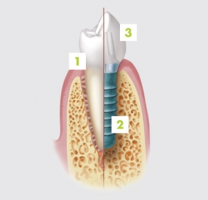 principe de l'implant dentaire