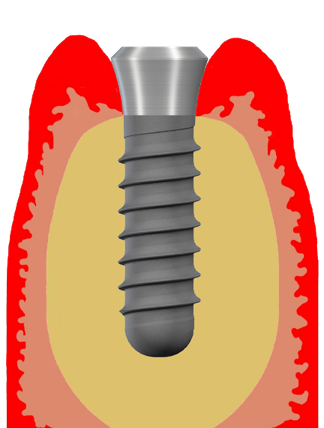 implant non enfoui