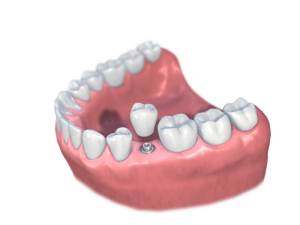 prothèse sur implant d'une seule dent