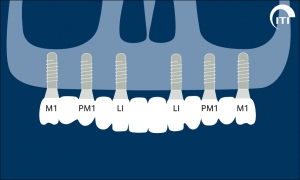 remplacement de toutes les dents 2