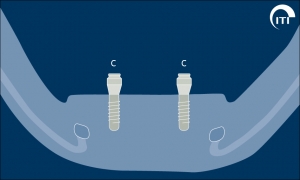 remplacement de plusieurs dents