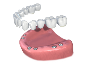 remplacement de toutes les dents