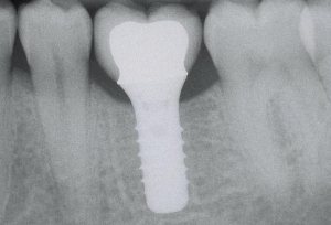radiographie d'implant et couronne