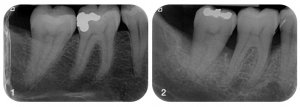radiographies de parodonte