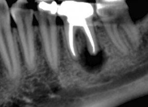 vue radiographique de résection apicale